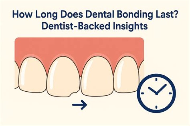 How long does bonding last?