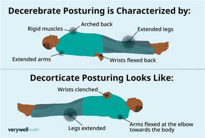 How long does decorticate posturing last?