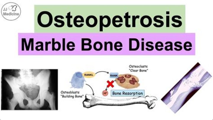 How to confirm osteopetrosis?