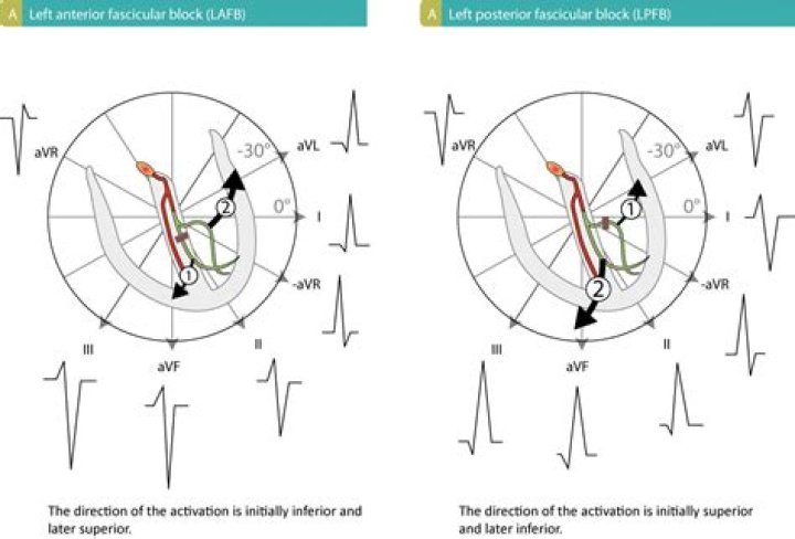 How to diagnose left posterior fascicular block?