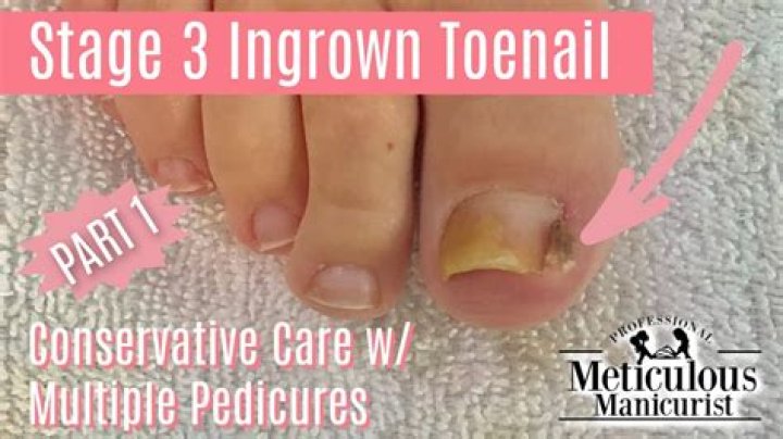 How to get rid of granulation tissue ingrown toenail?