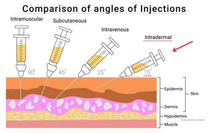 How to inject intradermal injection?
