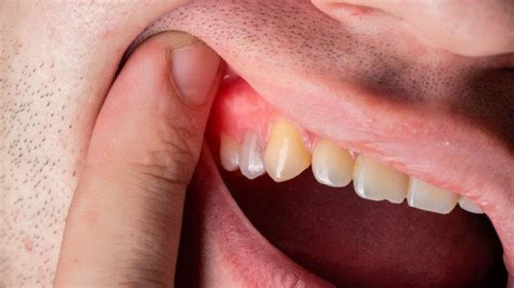 How to pinken gums?