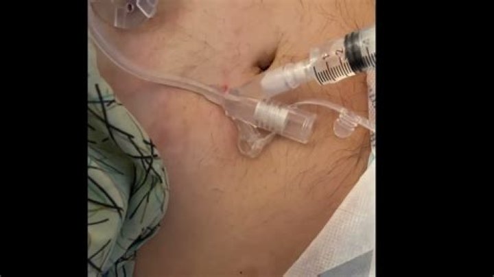 How to remove gastrostomy tube?