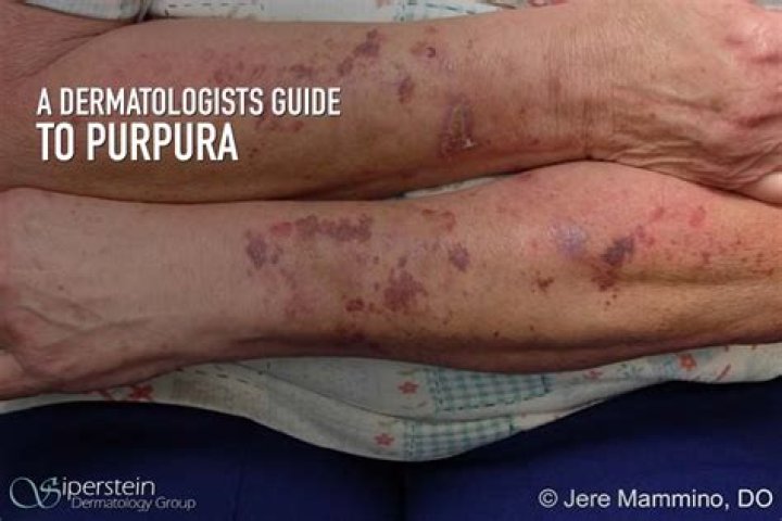 How to treat purpuric rash?