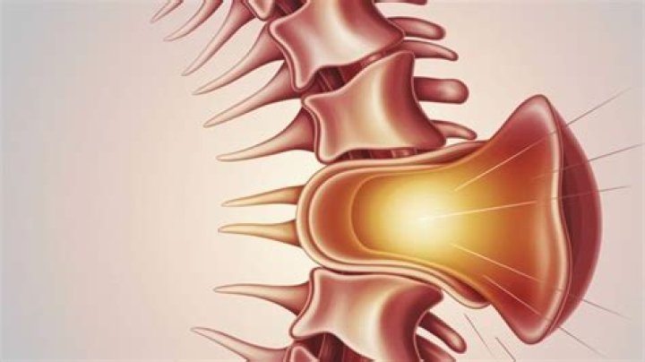How to treat thecal sac compression?