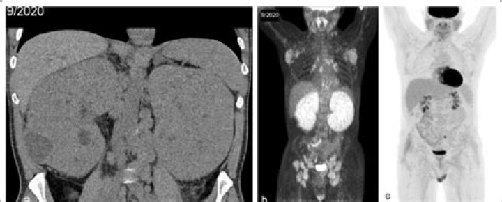 In the term nephromegaly?