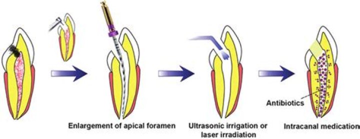 Intracanal medicaments in endodontics?
