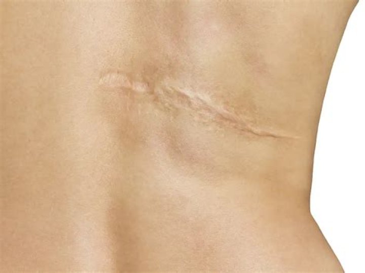 Is a scar considered disfigurement?