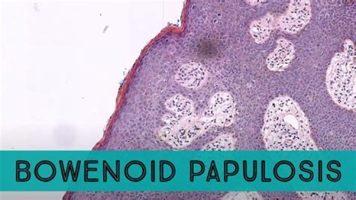 Is bowenoid papulosis cancer?