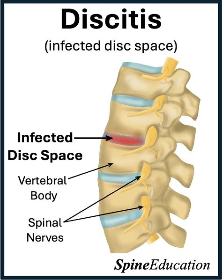 Is discitis an infection?