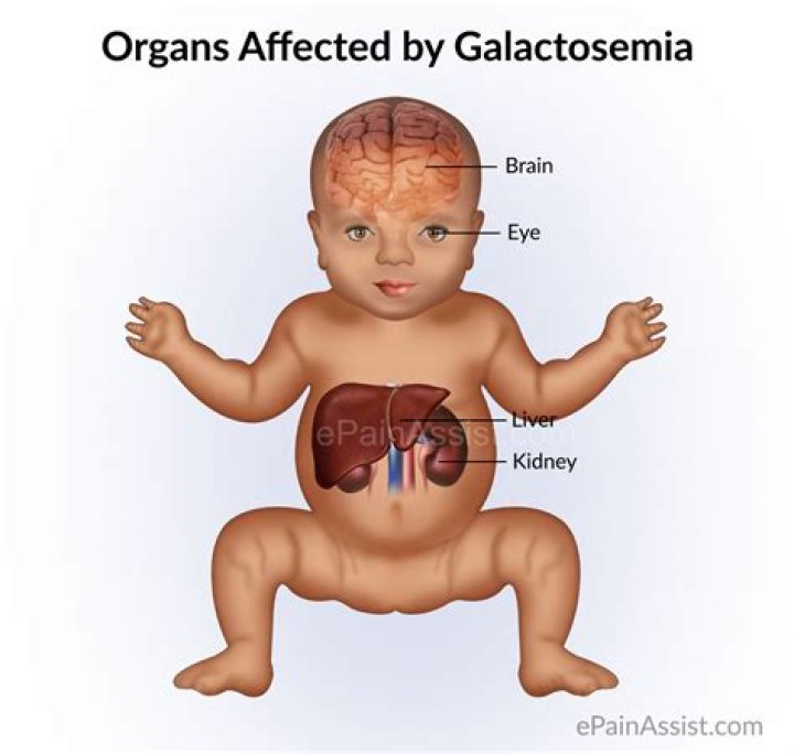 Is galactosemia a word?