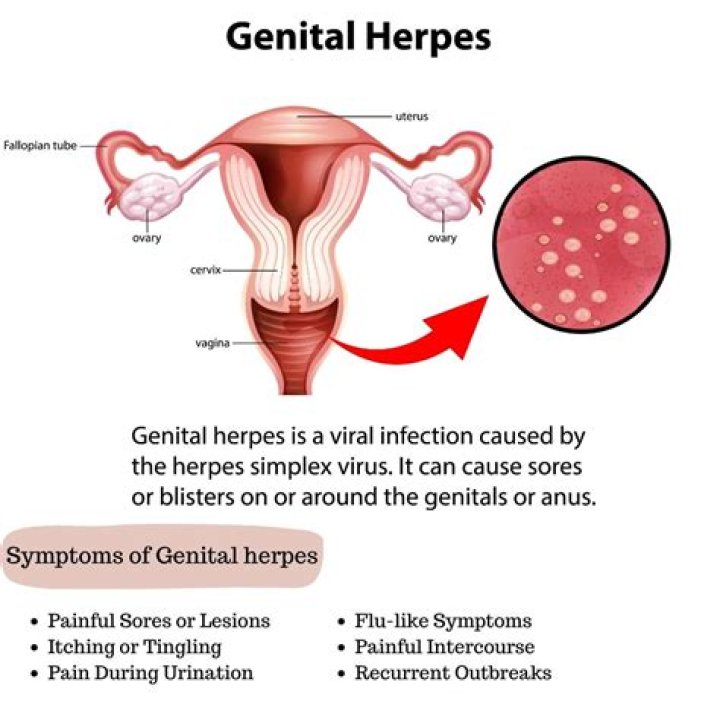 Is genital herpes incurable?