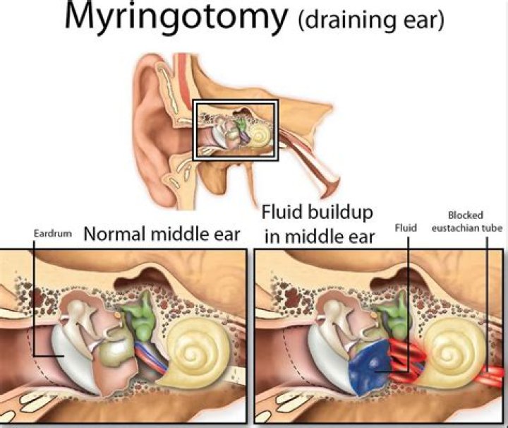 Is myringotomy a surgery?