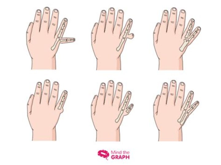 Is polydactylism a word?