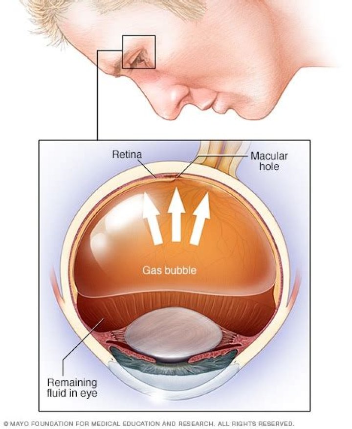 Is retinal detachment curable?