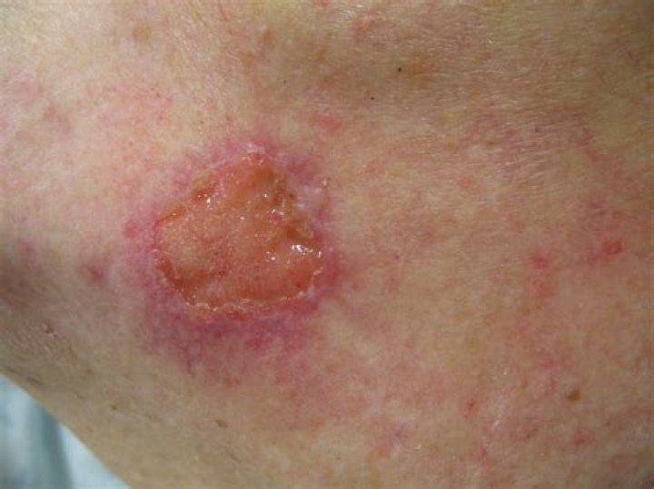 Is squamous cell carcinomas malignant?