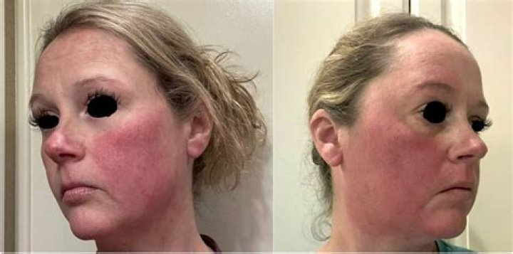 Is there a cure for erythromelalgia?