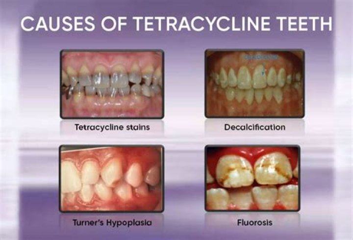 Should tetracycline be taken on an empty stomach?