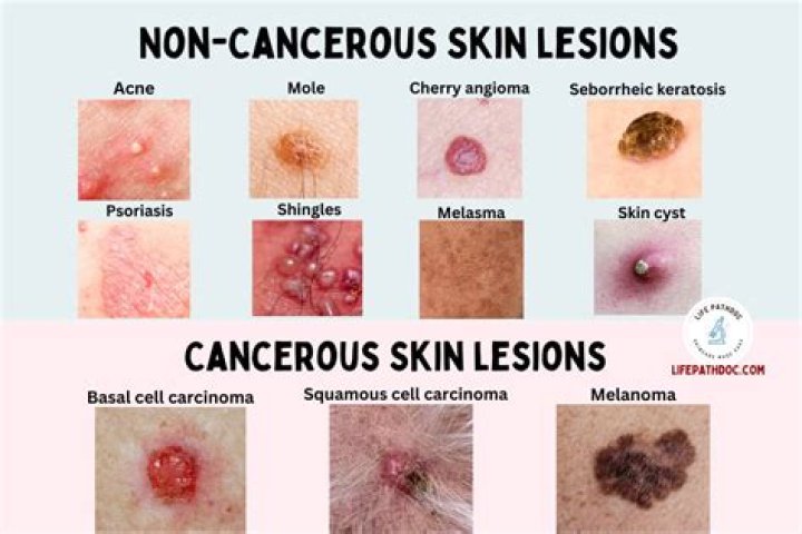 What are skin lesions?