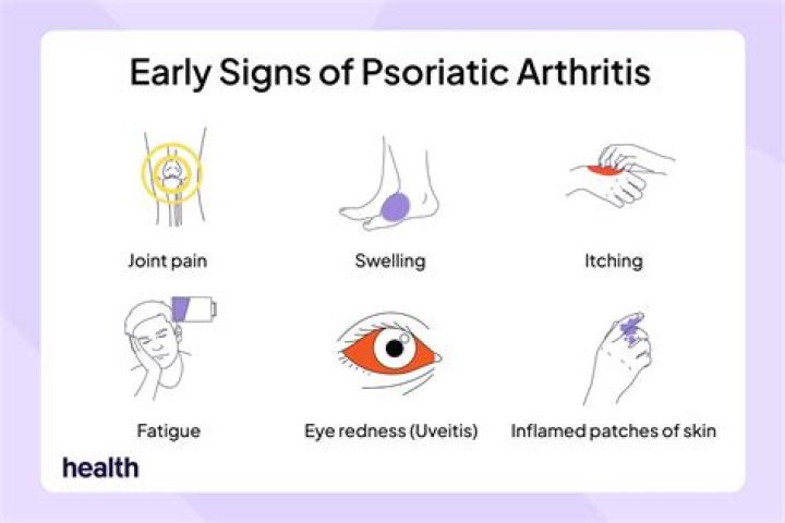 What are the early symptoms of psoriatic arthritis?