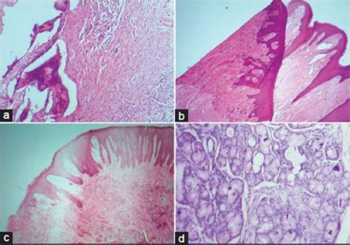 What are the most common microtomy artifacts found?
