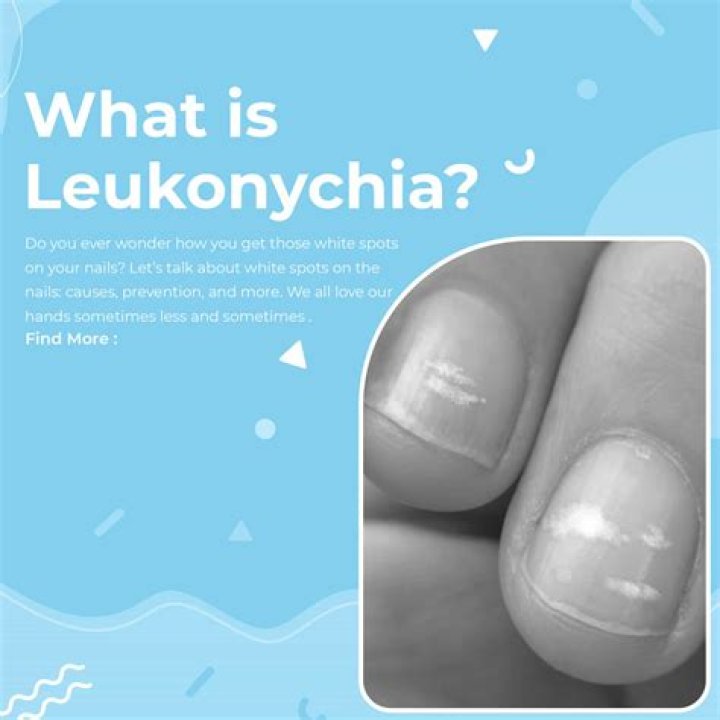 What causes leukonychia in the fingernails?