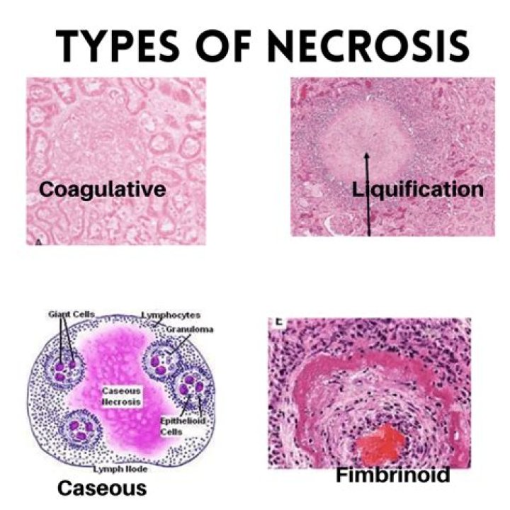What causes liquefactive necrosis?