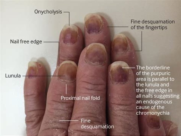 What causes purplish fingernails?