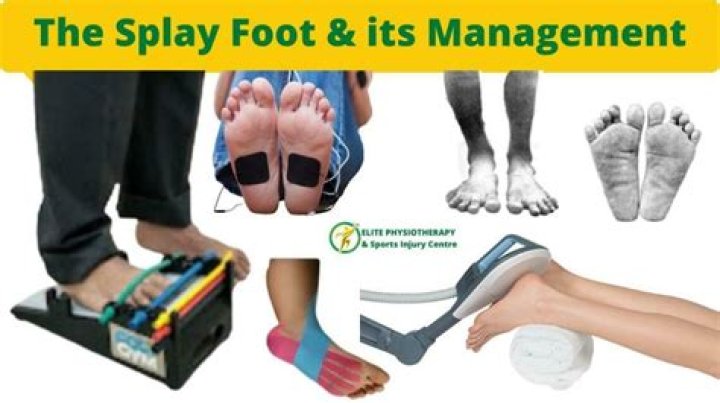 What causes splay foot?