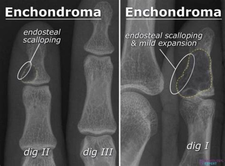 What does enchondroma mean?
