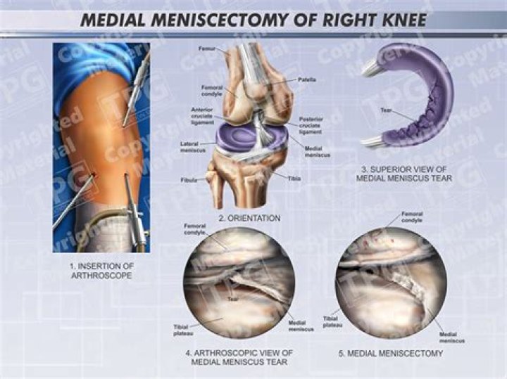 What does meniscectomy stand for?