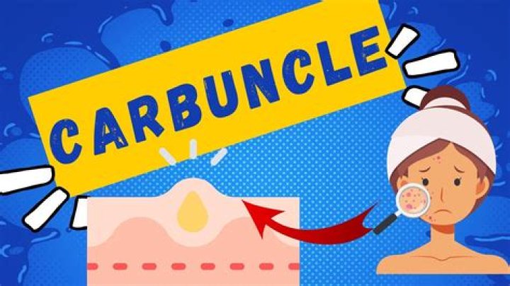 What does the word carbuncular mean?