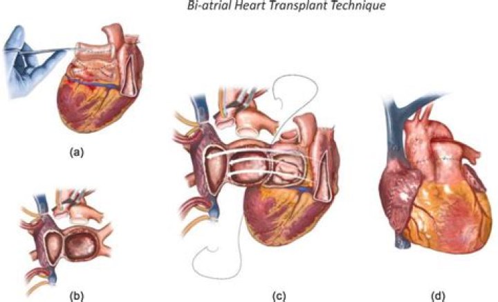 What does the word cardiectomy mean?