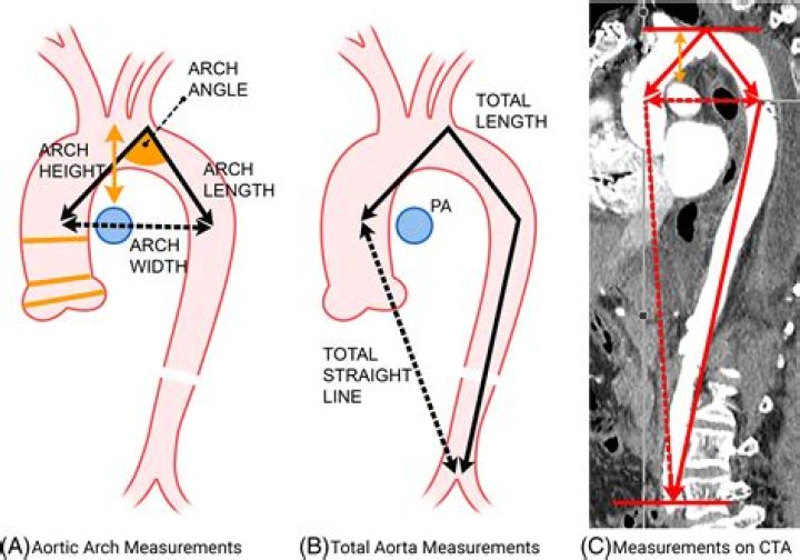 What does tortuosity of the thoracic aorta mean?