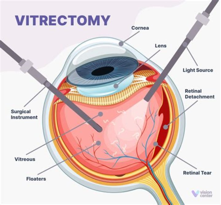 What does vitrectomy mean?