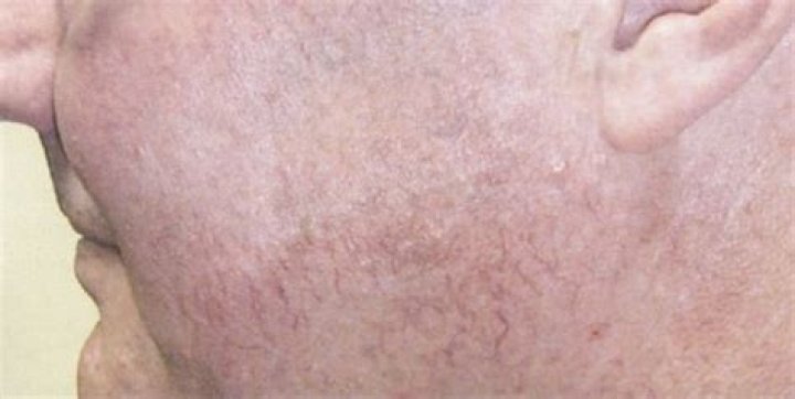 What is a plethoric appearance?