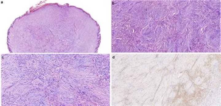 What is an epidermal collarette?
