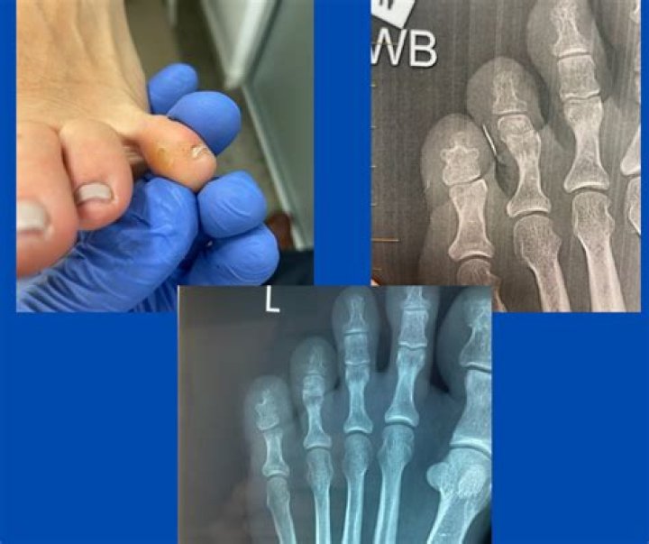 What is an interdigital corn?