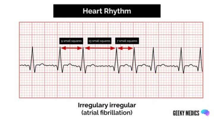 What is an irregularly irregular rhythm?