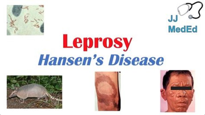 What is diffuse lepromatous leprosy?
