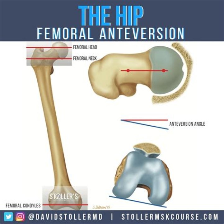 What is femoral neck anteversion?