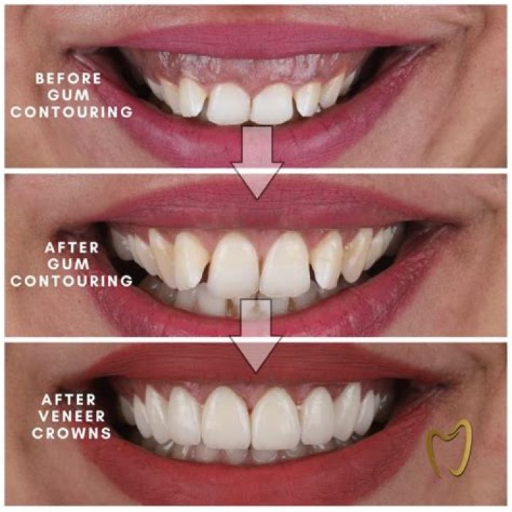 What is gum contouring?