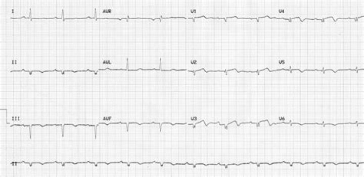 What is low qrs voltage in precordial leads?