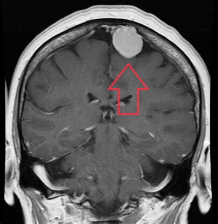 What is the average size of a meningioma?
