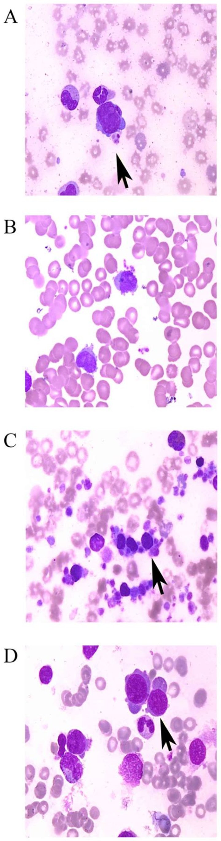 What is the clinical feature of acute megakaryocytic leukemia?