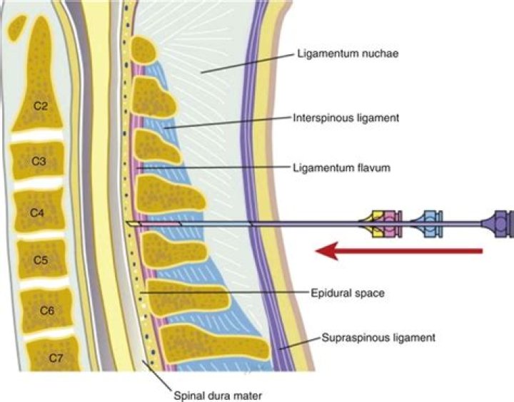What is the cpt code for a interspinous ligament injection?