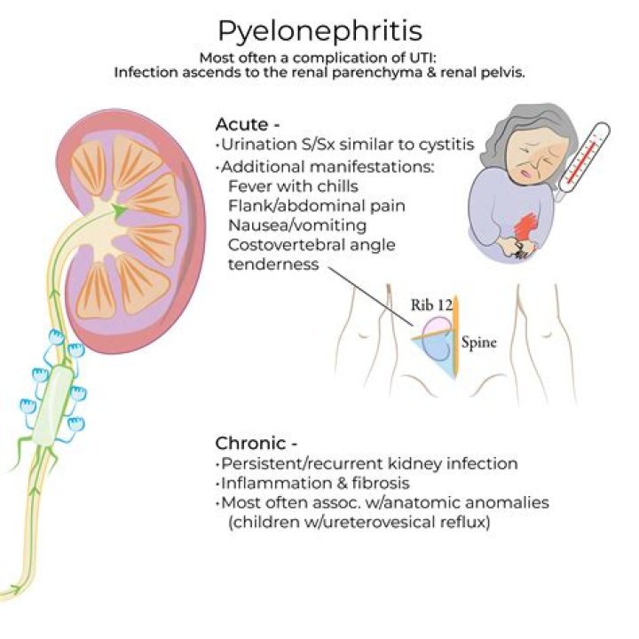 What is the medical definition for pyelonephritis?