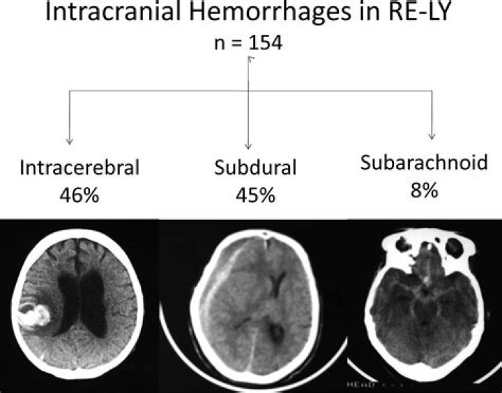 What is the most common cause of intracerebral hemorrhage?