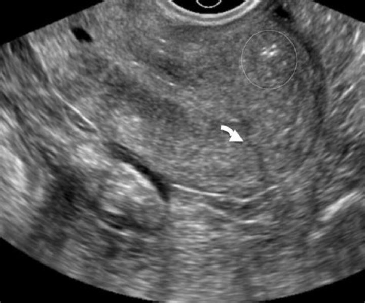 What is uterine perforation?